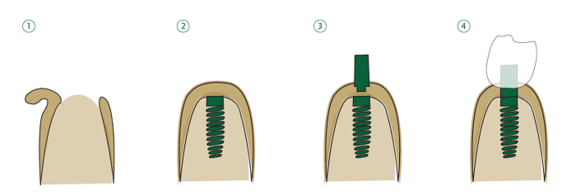 Zahnimplantate, Zahnarztangst, Dr. Desmyttère, smileforever München